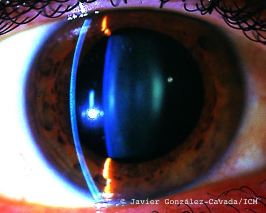 Ojo con iluminación de lámpara directa