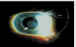 Iluminación en  ojo con técnica de dispersión escleral