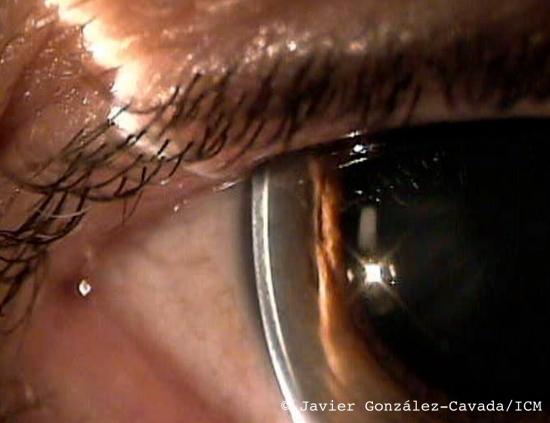 Iluminación en ojo técnica sección óptica