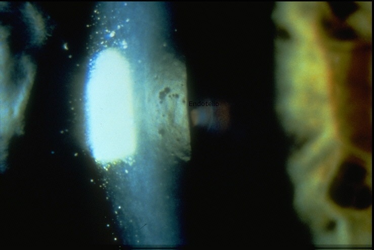 Iluminación en  ojo con técnica de reflexión especular