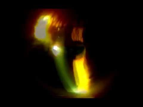 Iluminación utilizando retroiluminación directa en ojo 