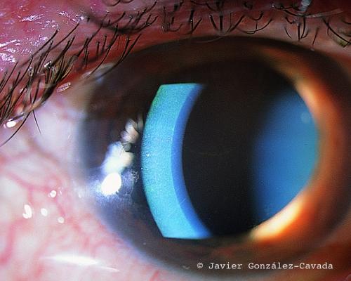 Iluminación en el ojo con técnica de paralelepípedo