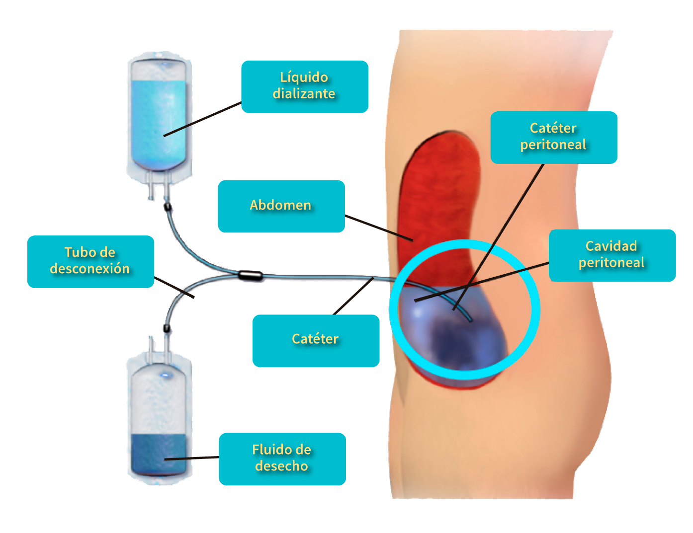 Diálisis peritoneal ambulatoria continua(DPCA)