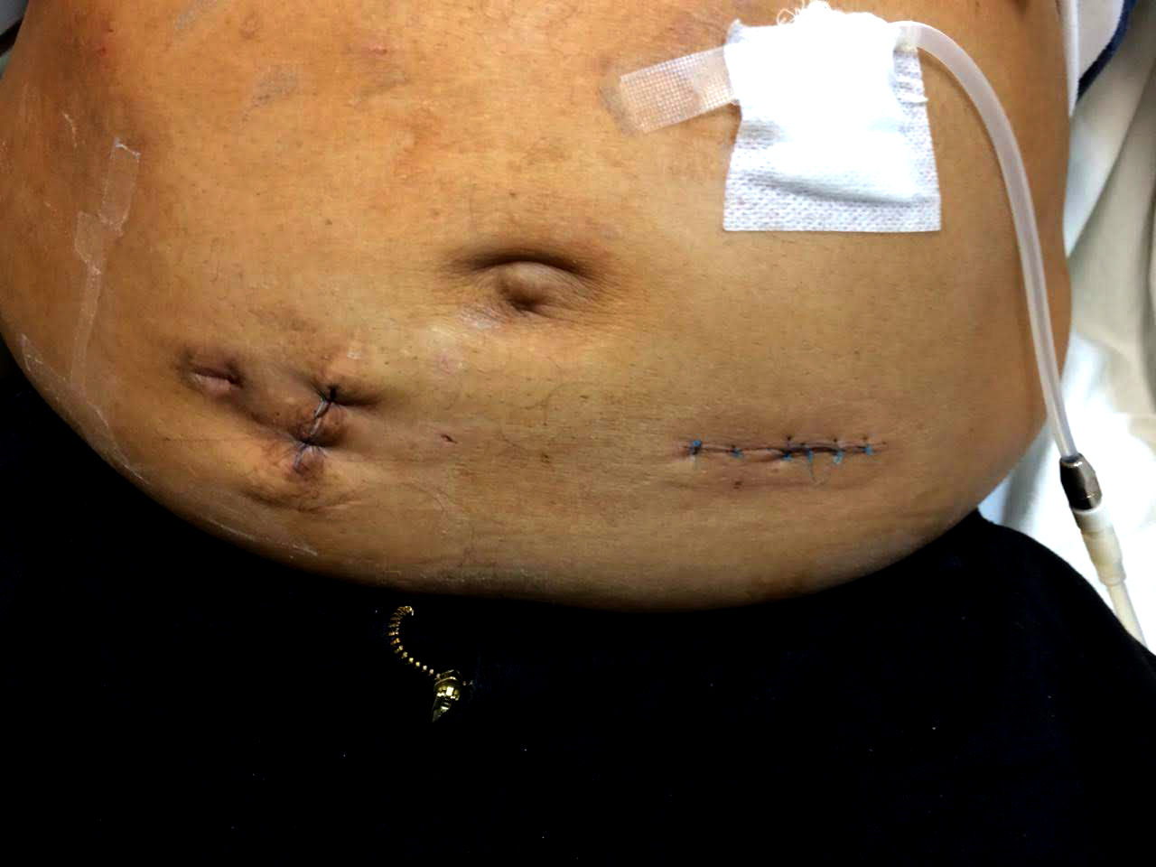 Sistema de diálisis peritoneal sobre paciente