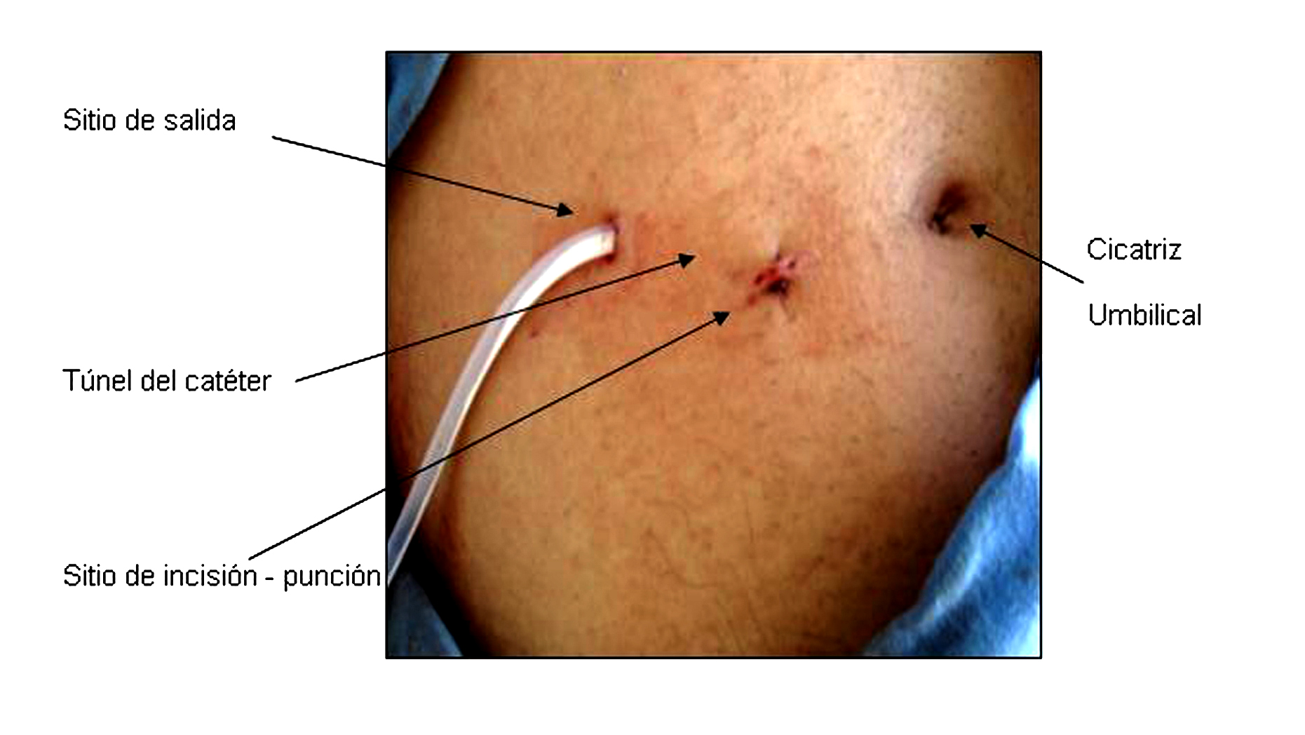 Instalación del catéter por inserción percutánea