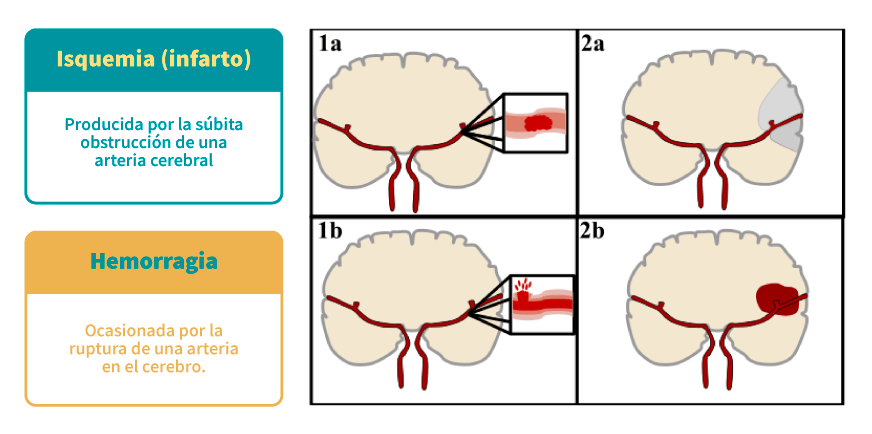 Clasificación del EVC