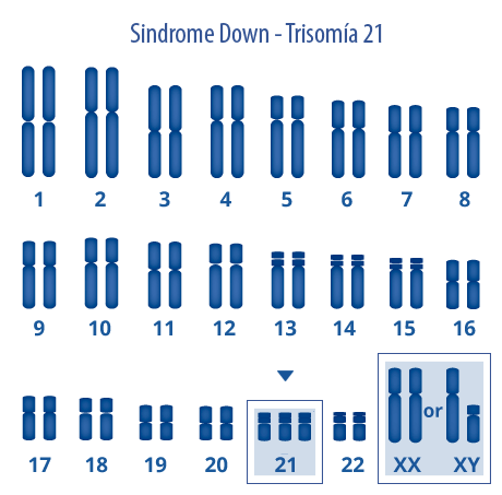 individuo con síndrome de Down.