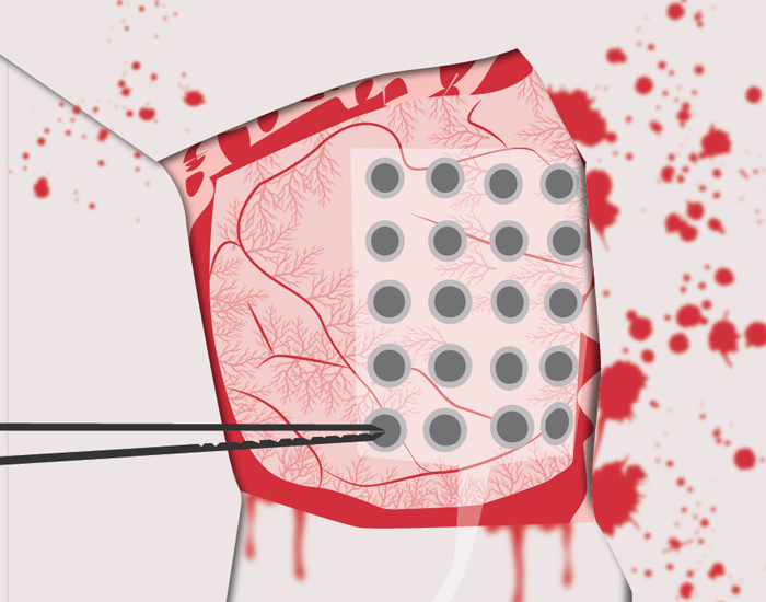 Técnica de electroencefalograma intracraneal