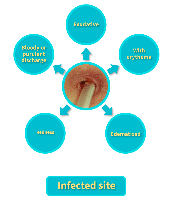 Characteristics of the infected catheter insertion site for PD