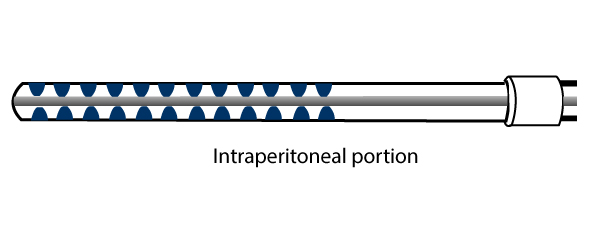 Porción intraperitoneal del catéter para DP