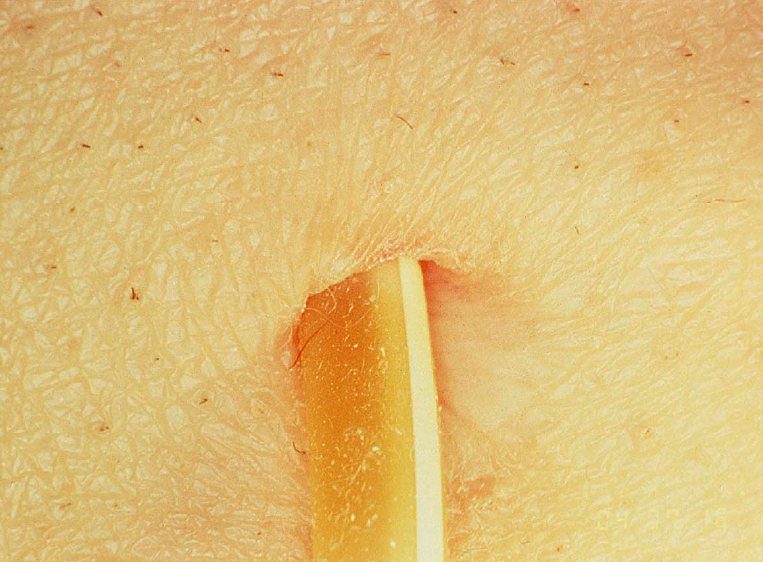 Sample of catheter installed