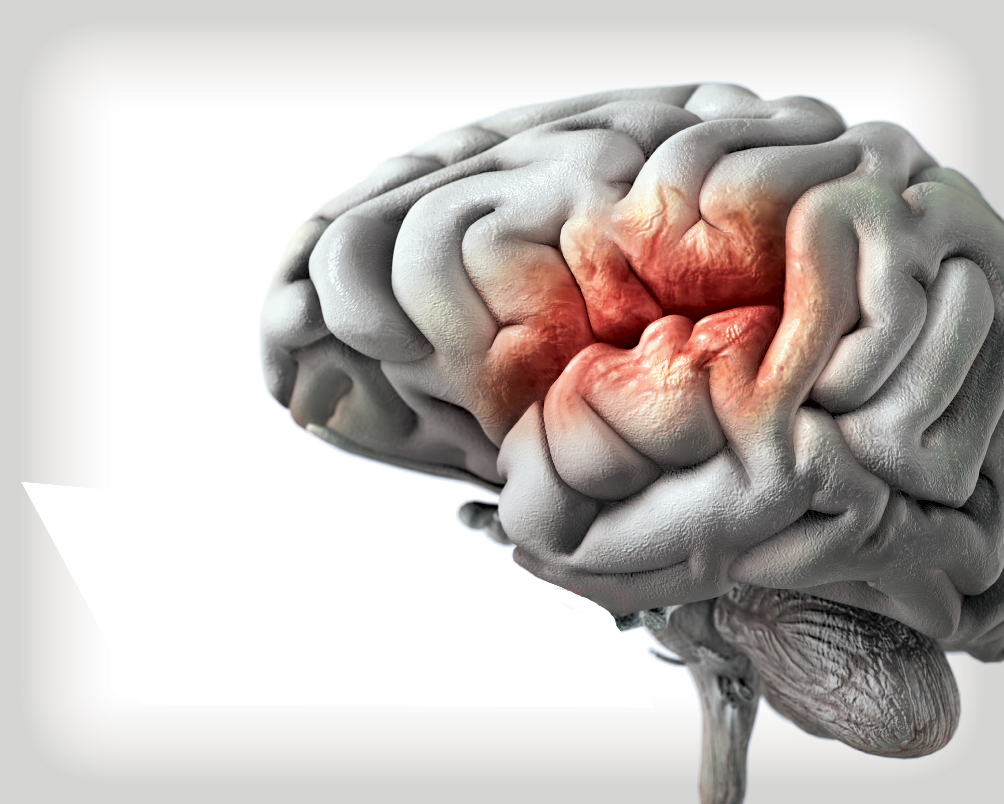 graphic of a brain with cerebral hemorrhage