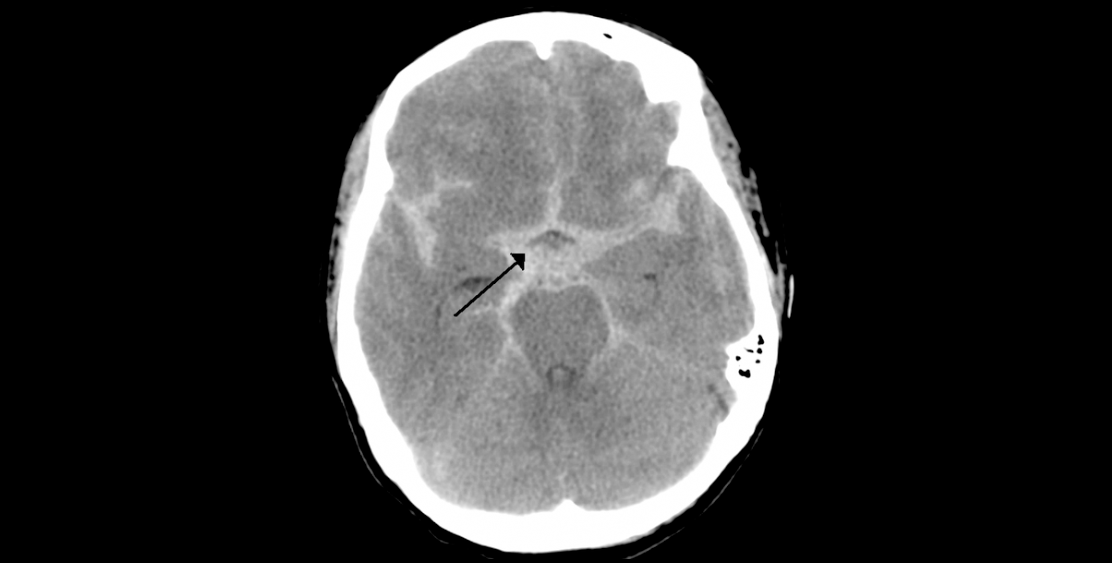 Data on subarachnoid hemorrhage