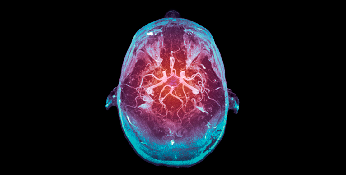 Circle of Willis Tomography