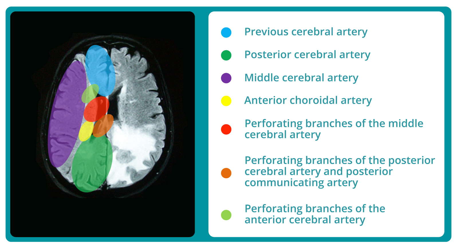Corte transversal de cerebro humano, el circuito cerebral arterial y sus principales áreas de irrigación